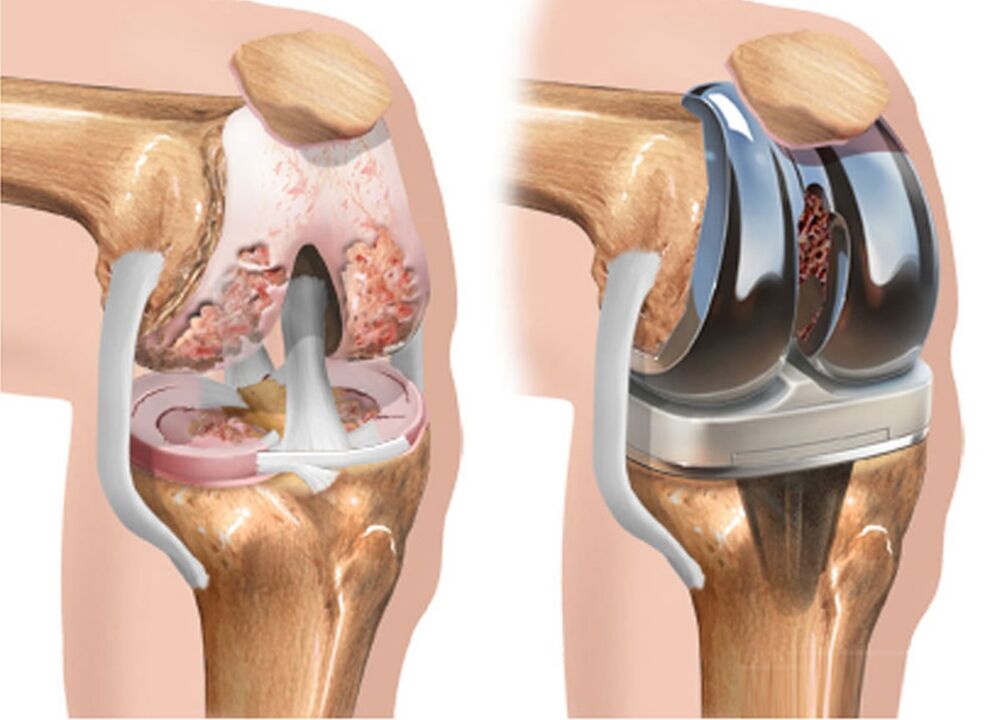 πριν και μετά την αρθρίτιδα της άρθρωσης του γόνατος για αρθρίτιδα