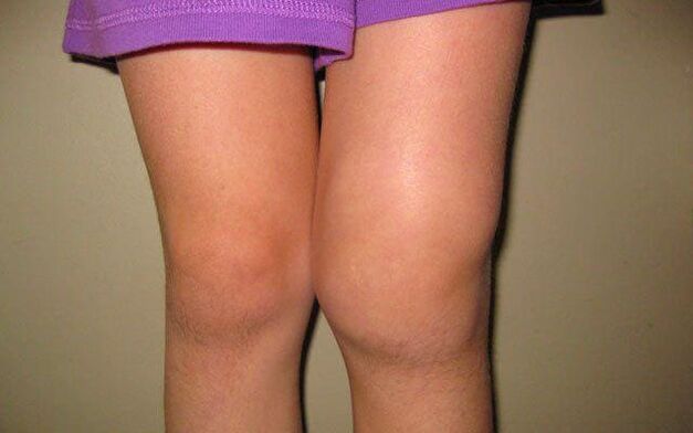 πρησμένη άρθρωση γόνατος λόγω οστεοαρθρίτιδας