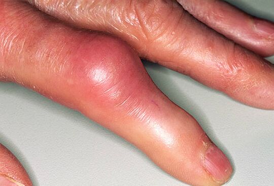 Η ουρική αρθρίτιδα συνοδεύεται από οξύ πόνο στα δάχτυλα και πρήξιμο των αρθρώσεων. 
